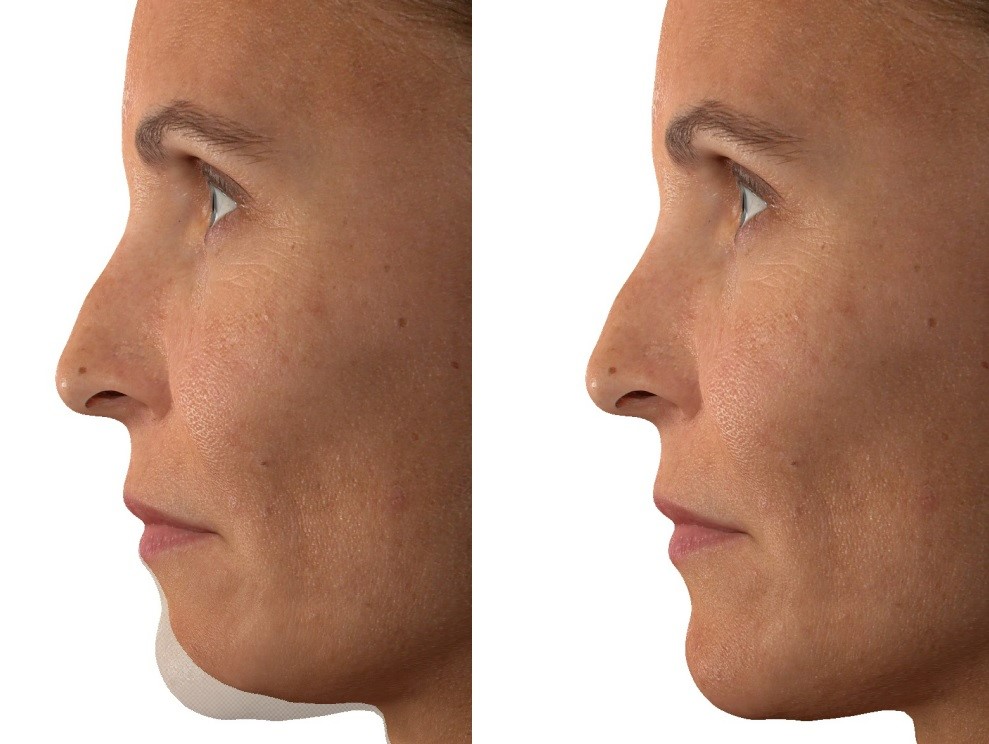 Chin Implant Simulation Mathew Epps MD Plastic Surgery Bluffton, SC