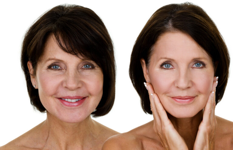 Non-Surgical Facial Rejuvenation and Facelift Surgery Mathew Epps MD Plastic Surgery Bluffton SC